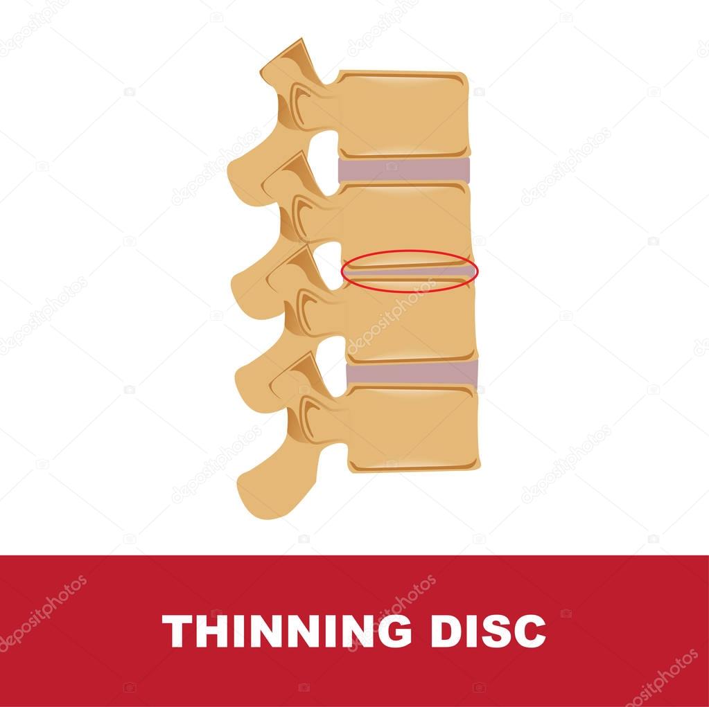  thinning disc vector illustration