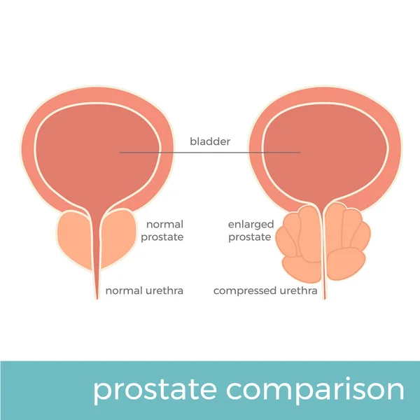 Ilustração Vetorial Comparação Normal Alargada Próstata — Vetor de Stock