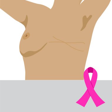 vektör çizim görünür bir ameliyat sonrası yara izi mastektomi sonra bir kadın tasvir. meme kanserine karşı mücadelede kazanan