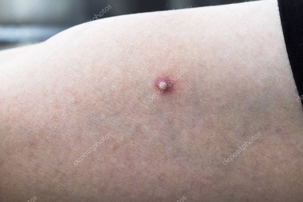 Big Whitehead Pimple, Zits, Acne on a Male Arm