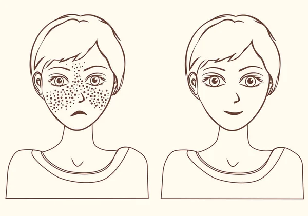 Concepto para niña eliminar pecas esquema . — Vector de stock