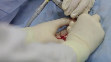 Ameliyat için Kaldır böbrek taşı. 