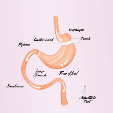 illustration of gastric band clipart