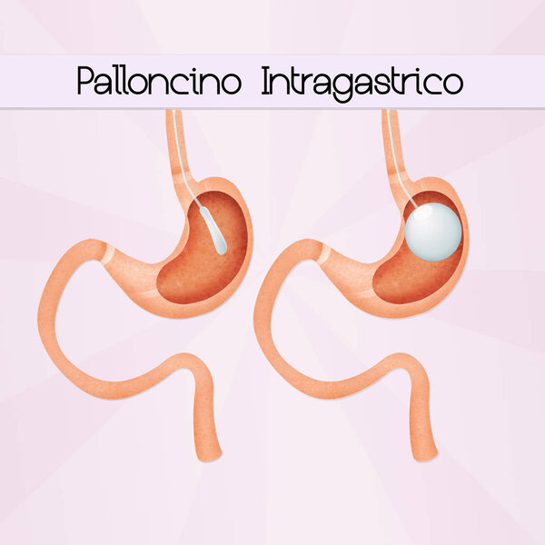 illustration of intragastric balloon