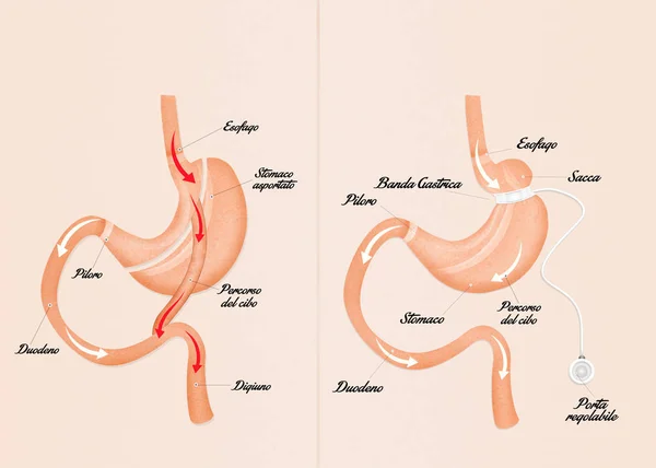 胃バイパス手術と胃バンド — ストック写真