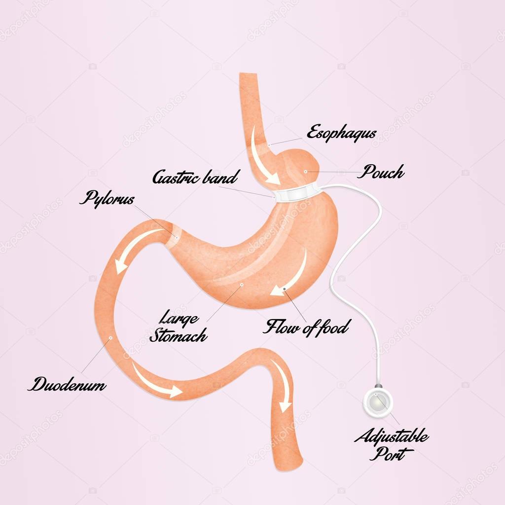illustration of gastric band