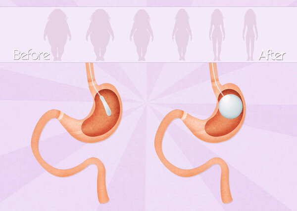 intragastric balloon surgery