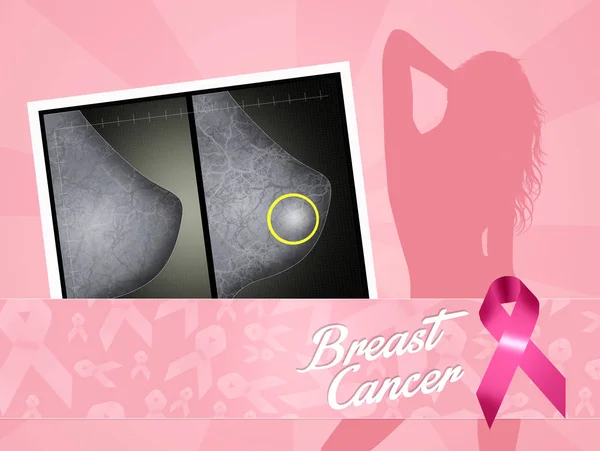 Illustration of Breast Cancer — Stock Photo, Image