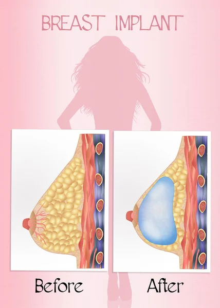 Antes e depois da cirurgia mamária — Fotografia de Stock