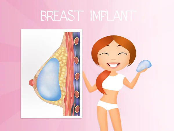 Ilustração do implante mamário — Fotografia de Stock