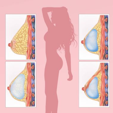 meme implantı çizimi