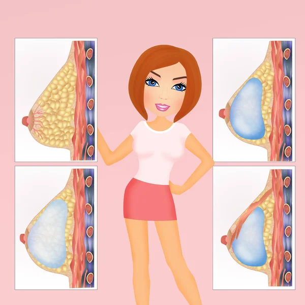 Bröstförstoring implantat flicka — Stockfoto