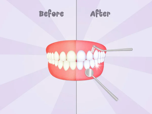 Before and after cleaning the teeth — Stock Photo, Image