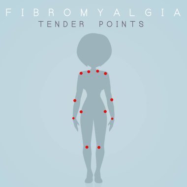 İhale noktaları fibromiyalji