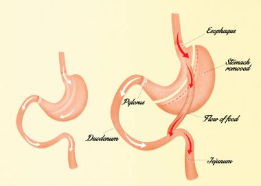 Gastrik bypass cerrahisi