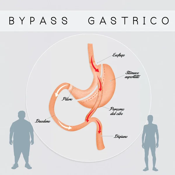 胃バイパス手術 — ストック写真