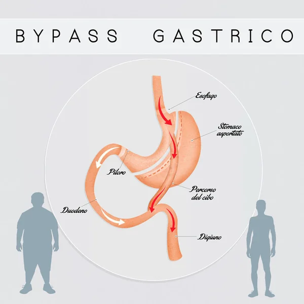 Cirurgia de bypass gástrico — Fotografia de Stock