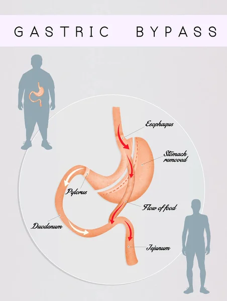 Gastric bypass-operation — Stockfoto