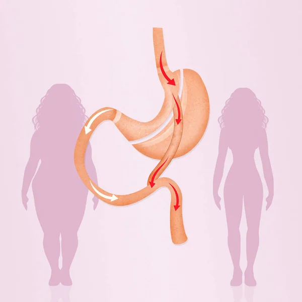 Операция шунтирования желудка — стоковое фото