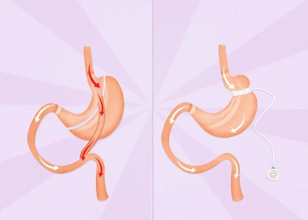 Gastric bypass and gastric band surgery — Stock Photo, Image