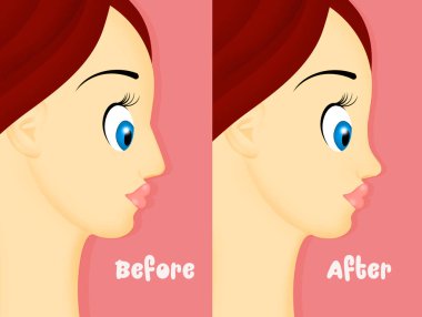 önce ve sonra rinoplasti gösteren resim