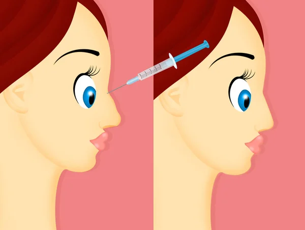 Illustration Hyaluronic Acid Injection Correct Nose — Stock Photo, Image