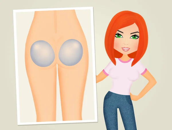 Illustration Implants Buttocks — Stock Photo, Image