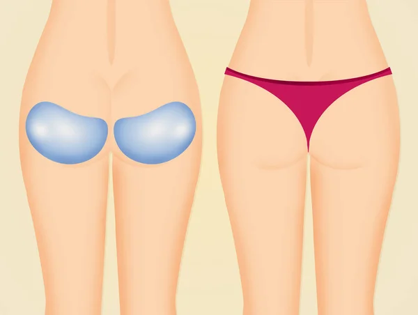 Ilustración Gluteoplastia Para Mujer — Foto de Stock