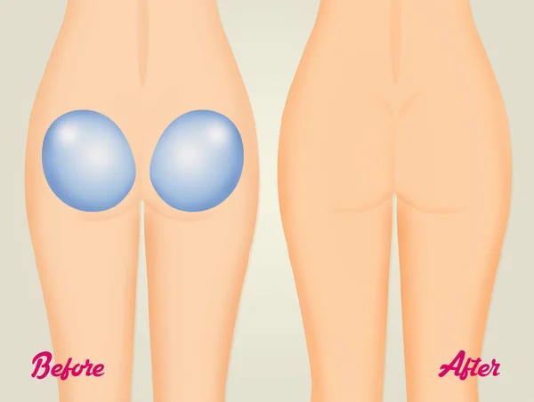 とお尻を改造後の図 — ストック写真