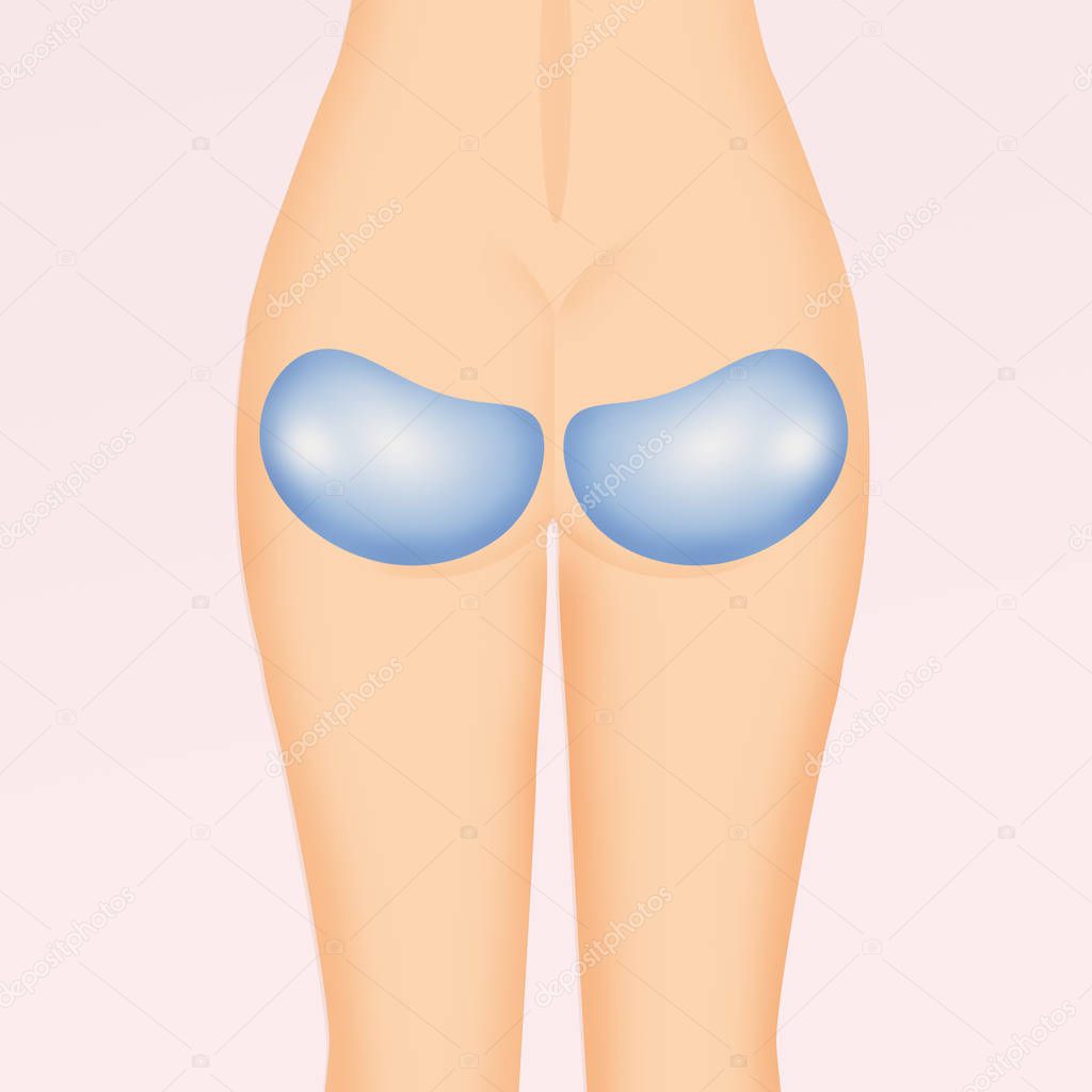 prosthesis in the buttocks