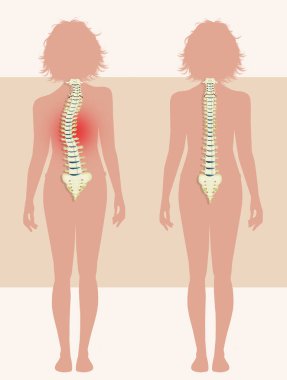 girl with scoliosis problem clipart
