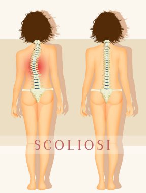 illustration of scoliosis disease clipart