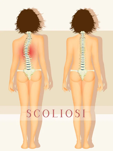 Illustrazione Della Malattia Scoliosi — Foto Stock