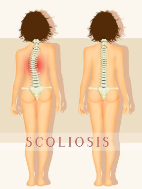 illustration of scoliosis problem clipart