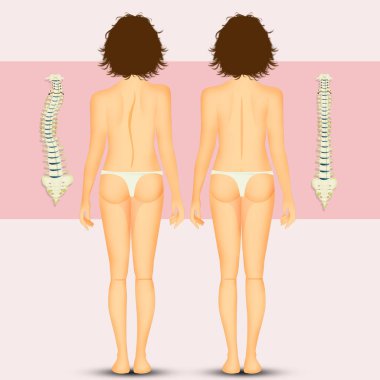 illustration of woman with scoliosis problem clipart