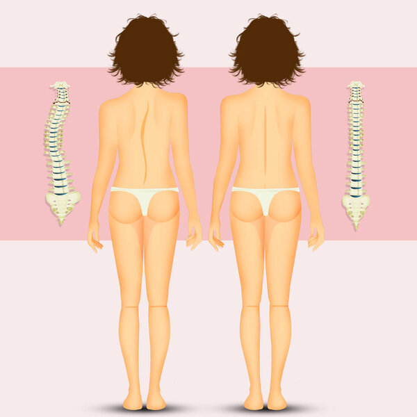 illustration of woman with scoliosis problem