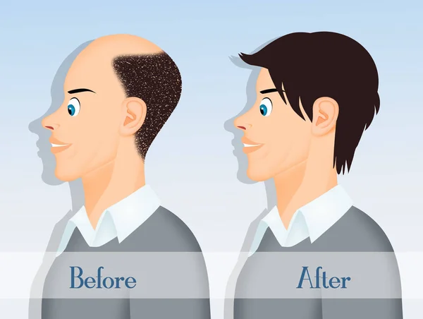 before and after hair transplantation