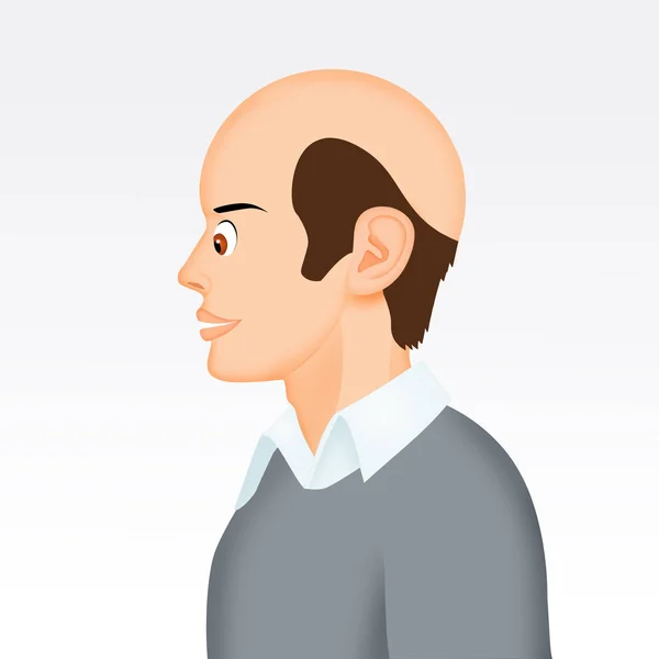 Ilustrace Muže Alopecií — Stock fotografie