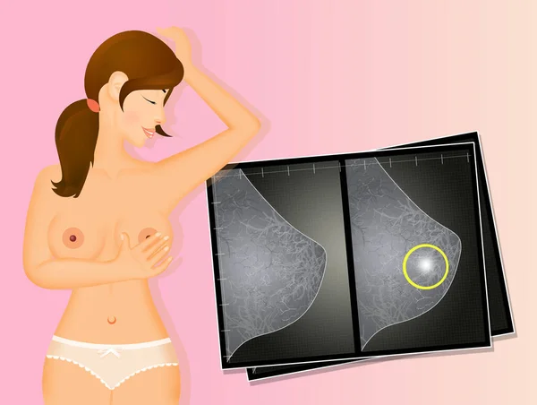 Illustration Kvinna Gör Mammogram — Stockfoto