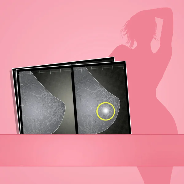 Ilustração Mamografia Para Mulheres — Fotografia de Stock