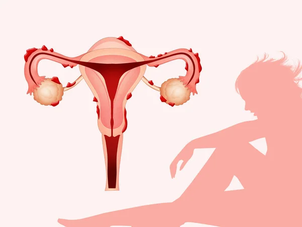 Endometriózis Betegség Illusztrációja Nők — Stock Fotó