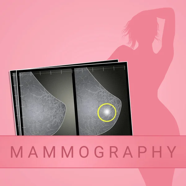 Ilustração Mamografia Mulher — Fotografia de Stock