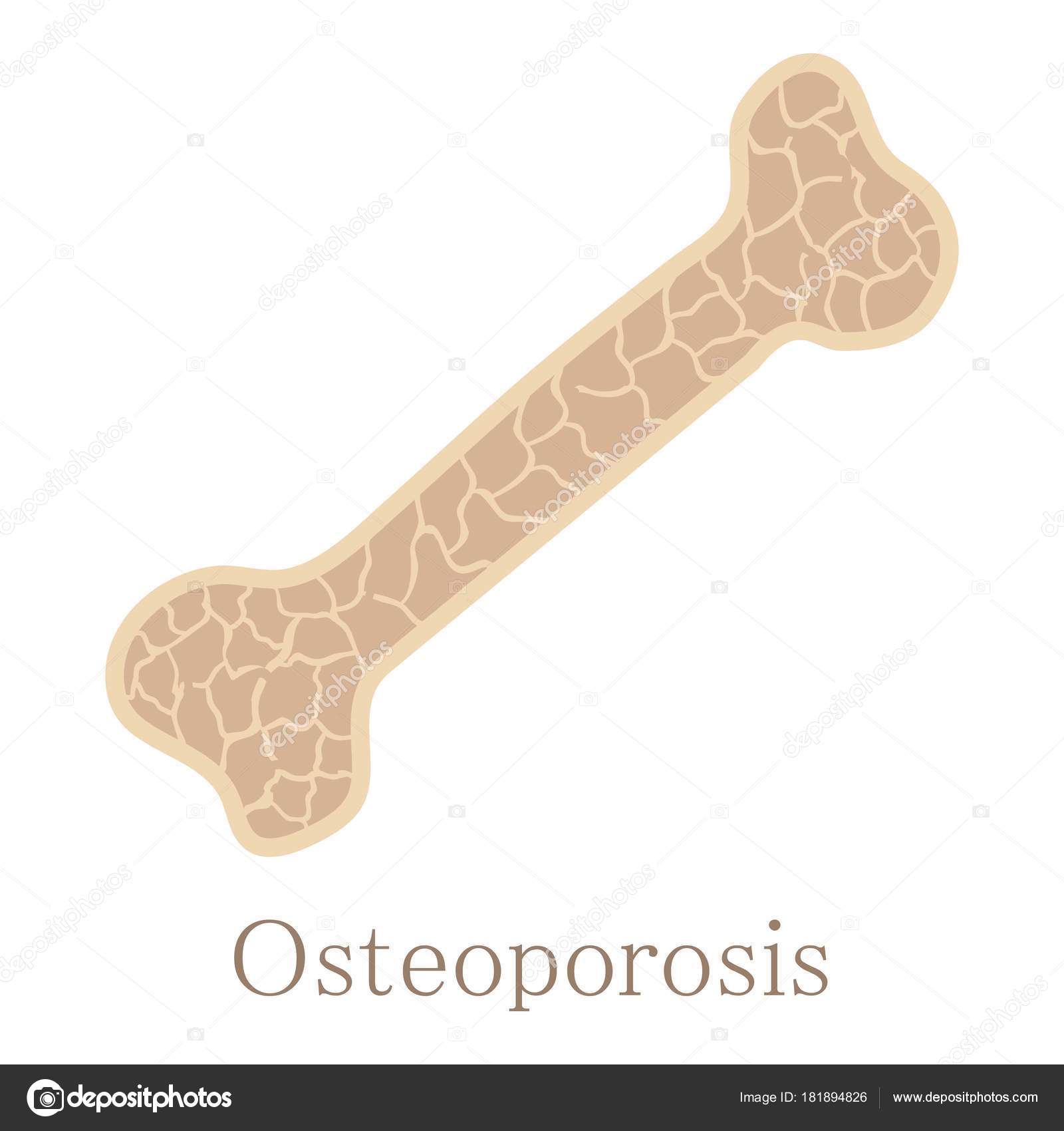 Osteoporosis bone icon, cartoon style Stock Vector Image by ©ylivdesign  #181894826