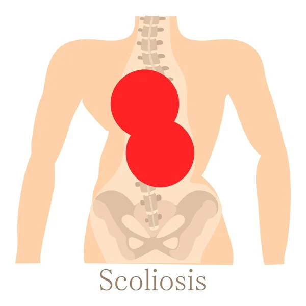 Icono de escoliosis, estilo de dibujos animados — Vector de stock