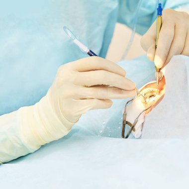 Oftalmoloji lazer mikroskop operasyonu. Klinikte doktor. Hasta göz tedavisi. Miyopi ve katarakt giderme