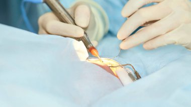 Oftalmoloji lazer mikroskop operasyonu. Klinikte doktor. Hasta göz tedavisi. Miyopi ve katarakt giderme