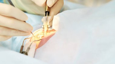 Oftalmoloji lazer mikroskop operasyonu. Klinikte doktor. Hasta göz tedavisi. Miyopi ve katarakt giderme