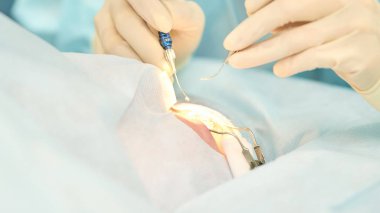 Oftalmoloji lazer mikroskop operasyonu. Klinikte doktor. Hasta göz tedavisi. Miyopi ve katarakt giderme