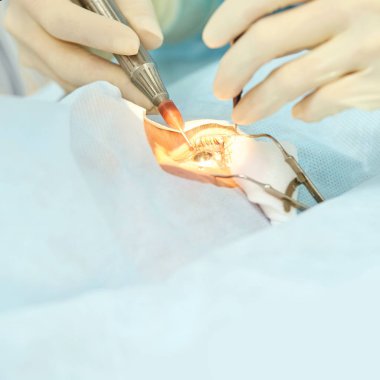 Oftalmoloji lazer mikroskop operasyonu. Klinikte doktor. Hasta göz tedavisi. Miyopi ve katarakt giderme