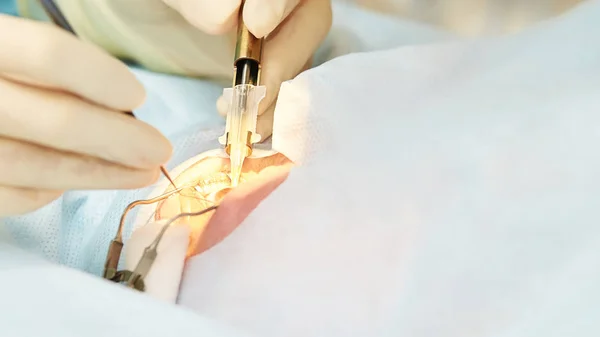 Operación de microscopio láser oftalmológico. Doctor en clínica. Tratamiento ocular del paciente. Miopía y eliminación de cataratas — Foto de Stock